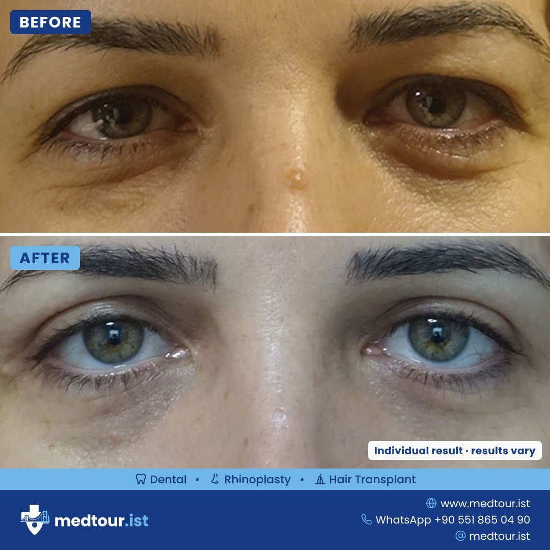 Eyelid surgery before and after, eye area only, individual result