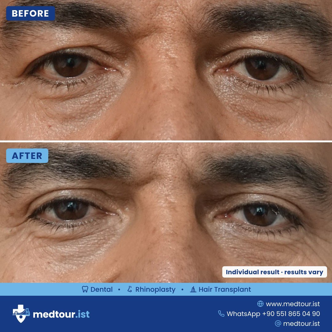 Upper and lower eyelid surgery before and after, eye area only, individual result