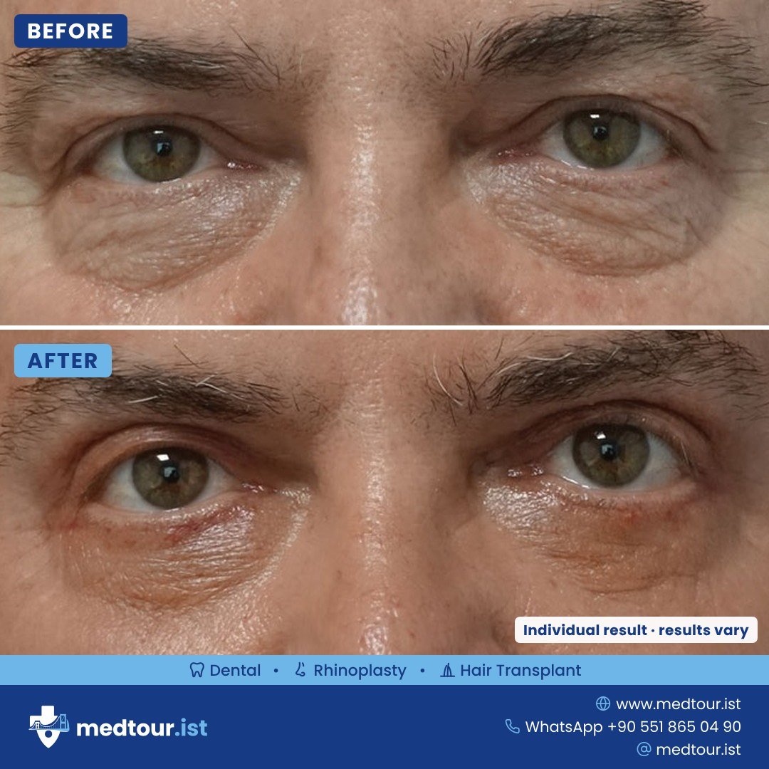 Blepharoplasty before and after, eye area only, individual result