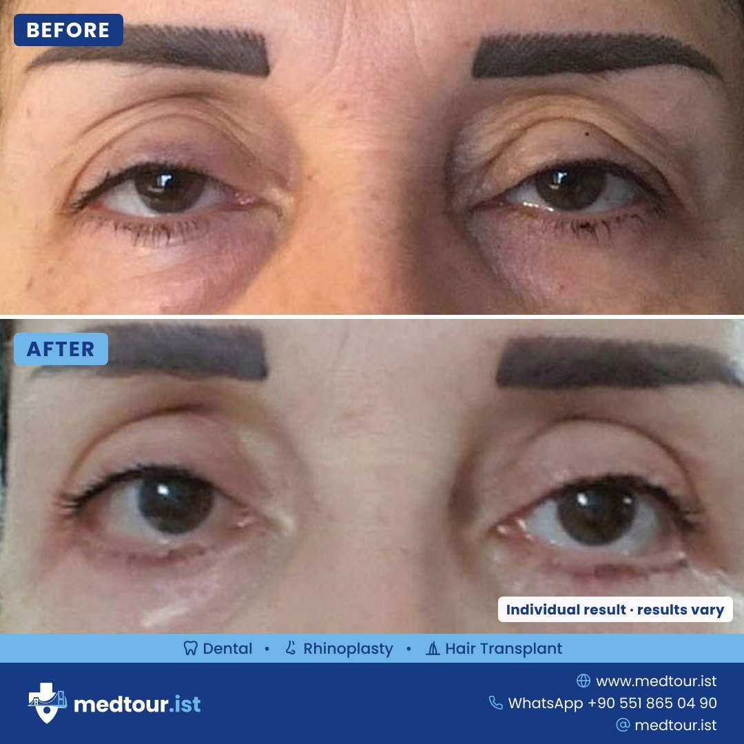 Upper eyelid surgery before and after, eye area only, individual result