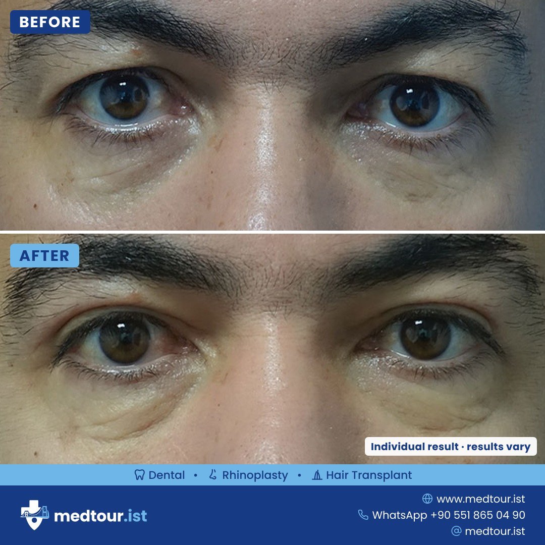 Eyelid surgery before and after, eye area only, individual result