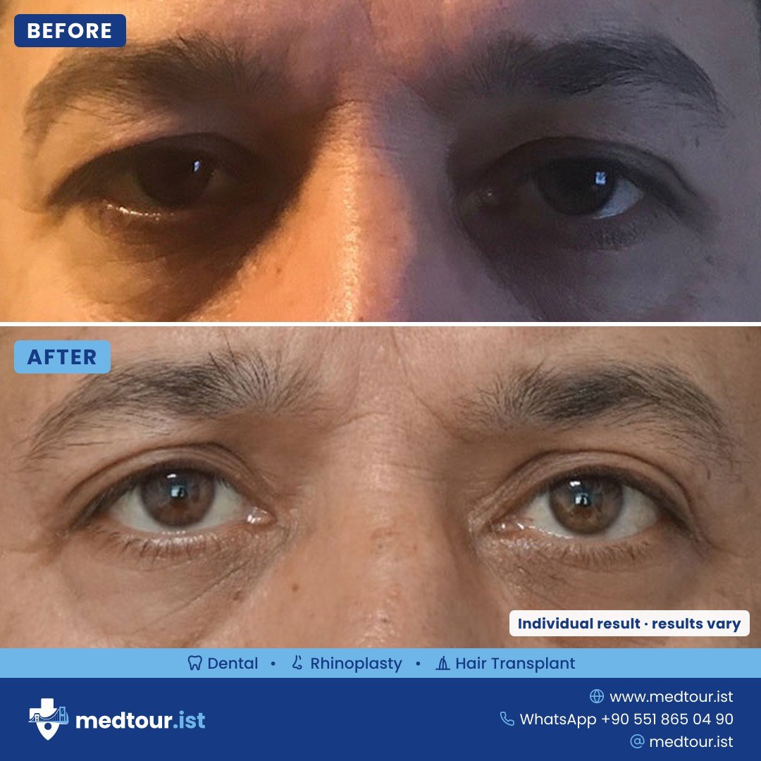 Blepharoplasty before and after, eye area only, individual result
