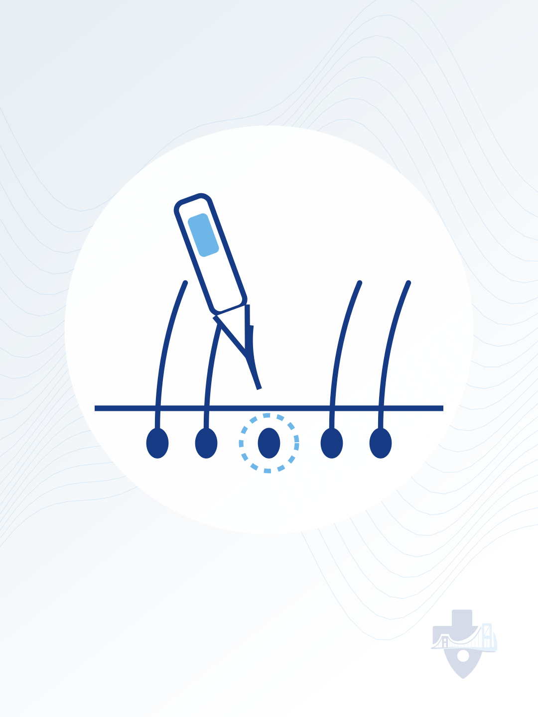 Illustration of hair transplant implantation
