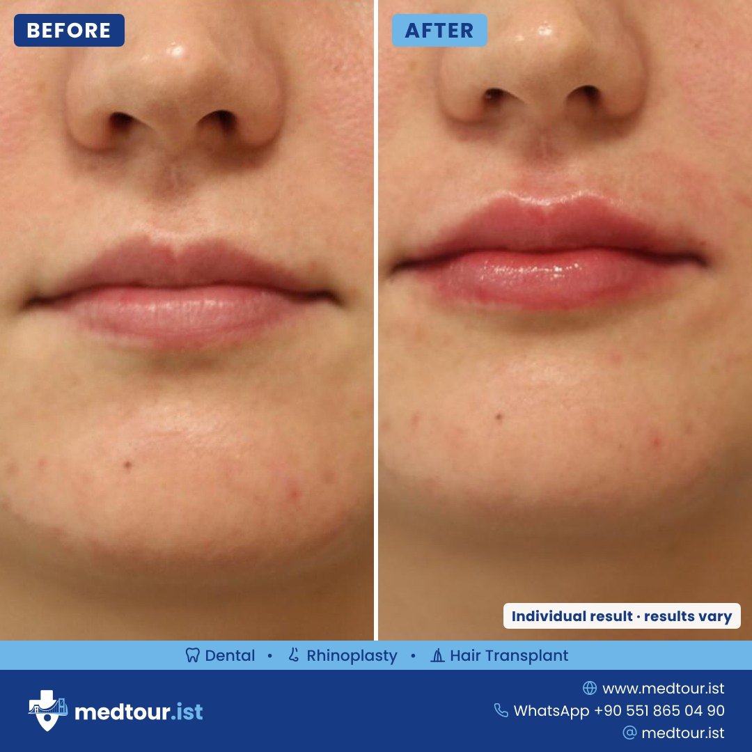 Lip augmentation before and after, lip area only, individual result