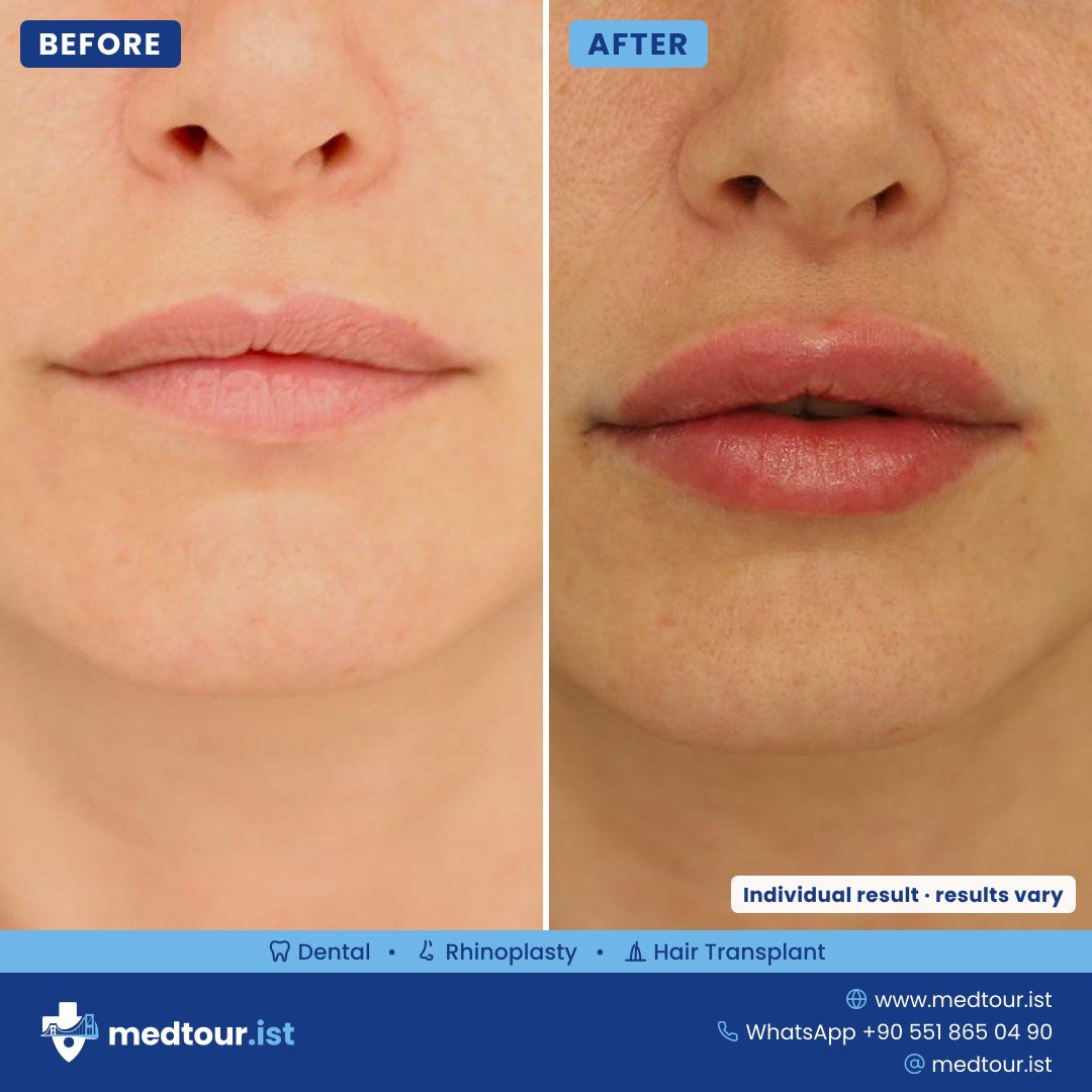 Lip augmentation before and after, lip area only, individual result