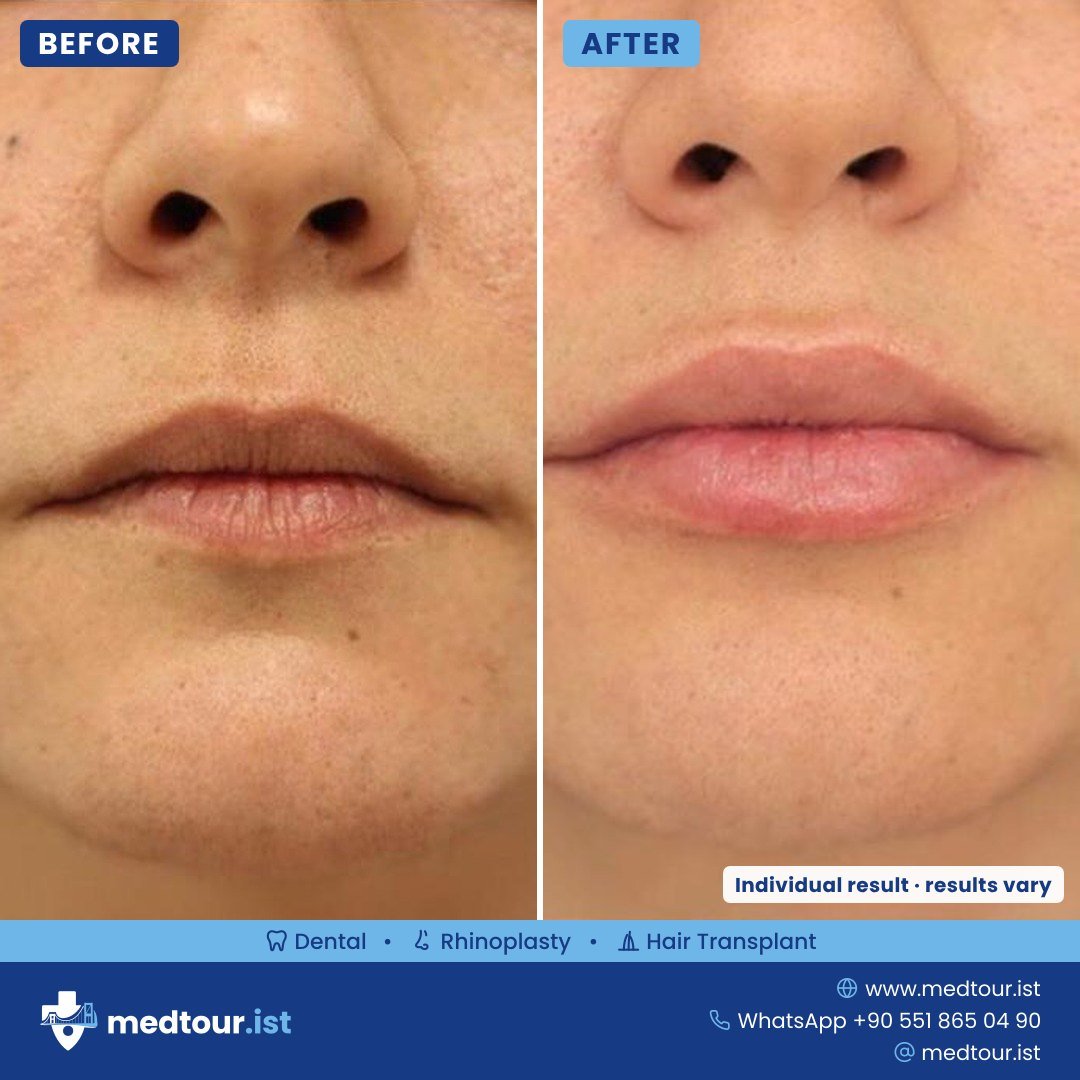 Lip augmentation before and after, lip area only, individual result