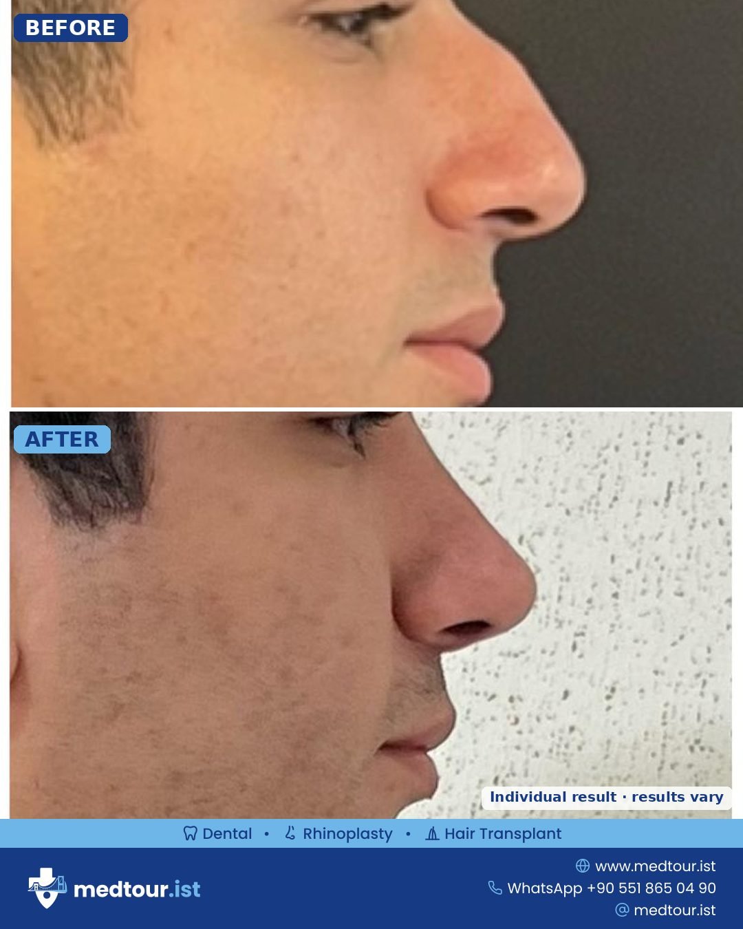 Rhinoplasty before and after: side profile, dorsal hump reduced