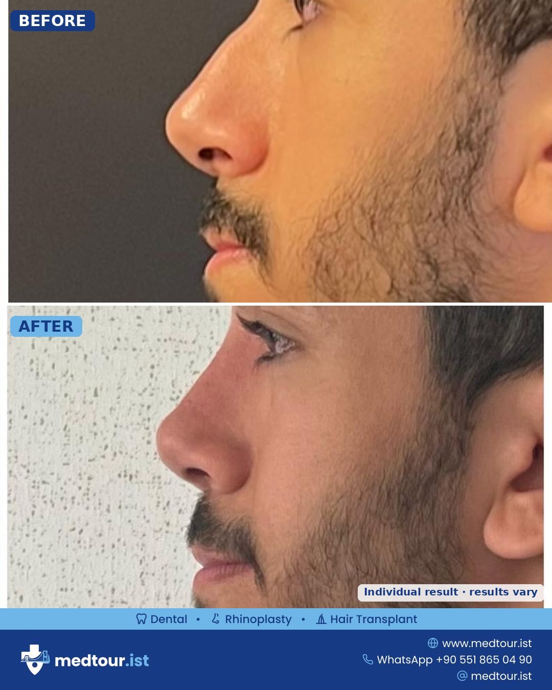 Rhinoplasty before and after: side profile, nasal bridge refined