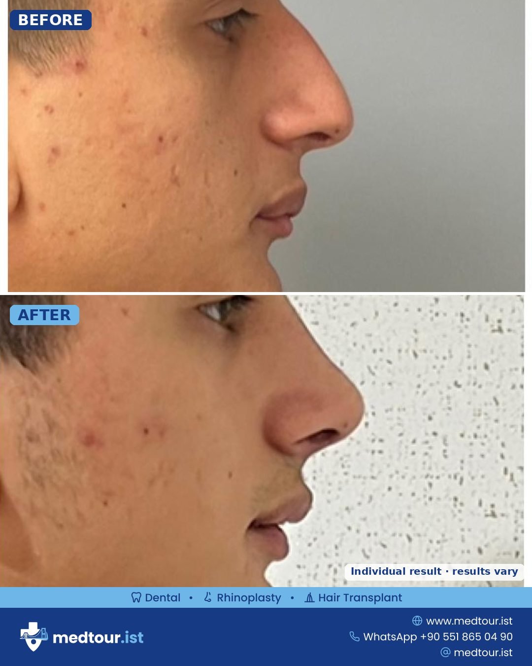 Rhinoplasty before and after: side profile, tip and bridge refined